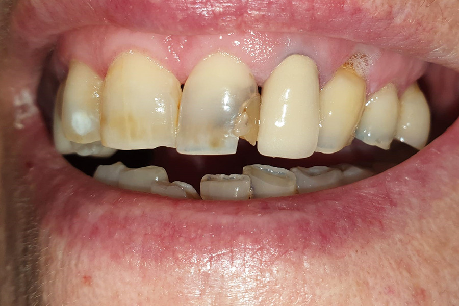 Cecilia prima di avere un nuovo sorriso con la faccette dentali