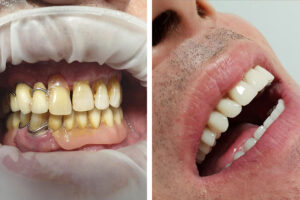 Impianti dentali. Il prima e dopo di Luciano