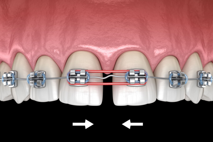 Apparecchio diastema