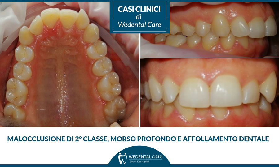 Malocclusione denti: caso clinico