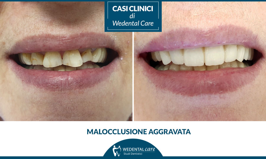 Maloccusione dentale, la soluzione di Wedental Care