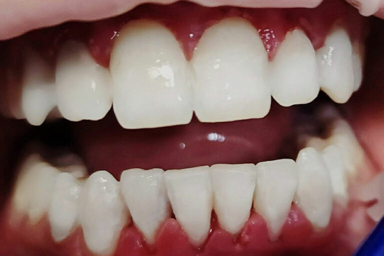 Colletti Dentali Prima E Dopo Colletti dentali: gravi erosioni diffuse | I casi clinici di Wedental Care