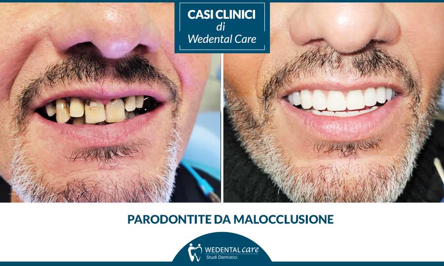 Cura della parodontite da malocclusione