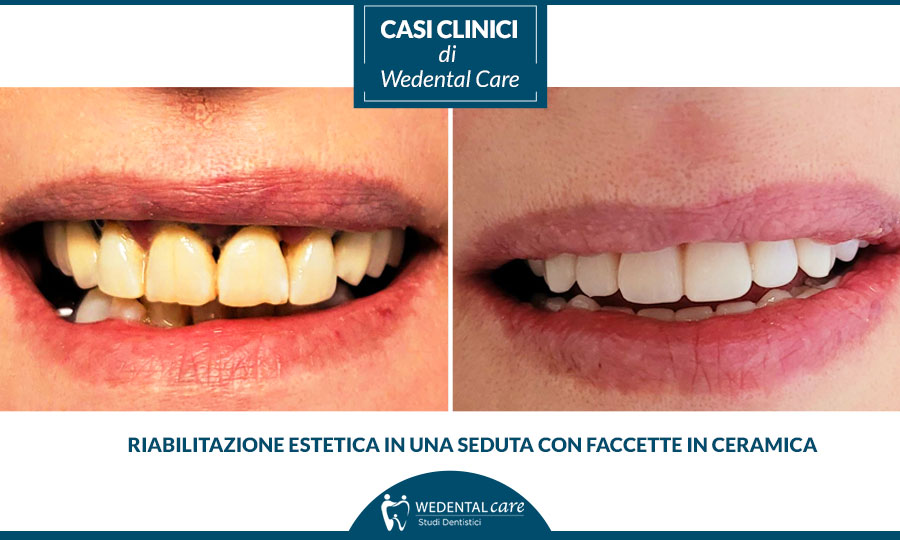 Riabilitazione estetica dentale