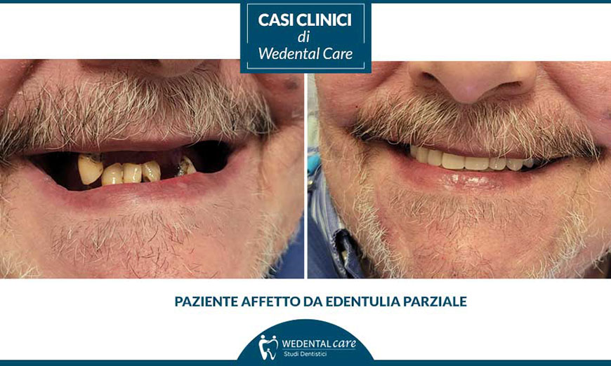 Paziente edentulo parziale