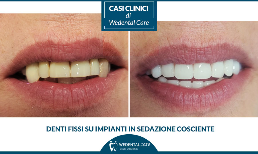 Impianti dentali per parodontite grave