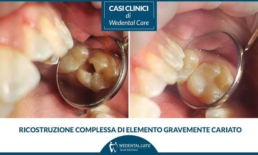 Ricostruzione dente cariato