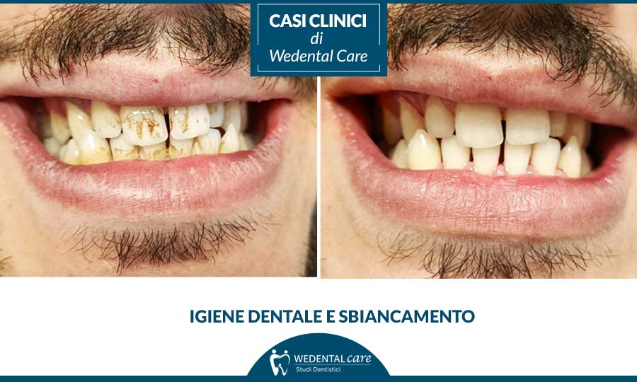 Igiene dentale e sbiancamento