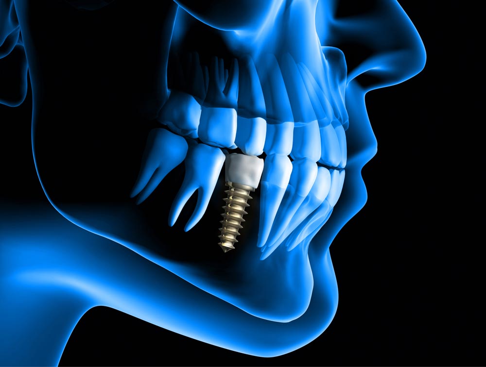 Impianti dentali Roma