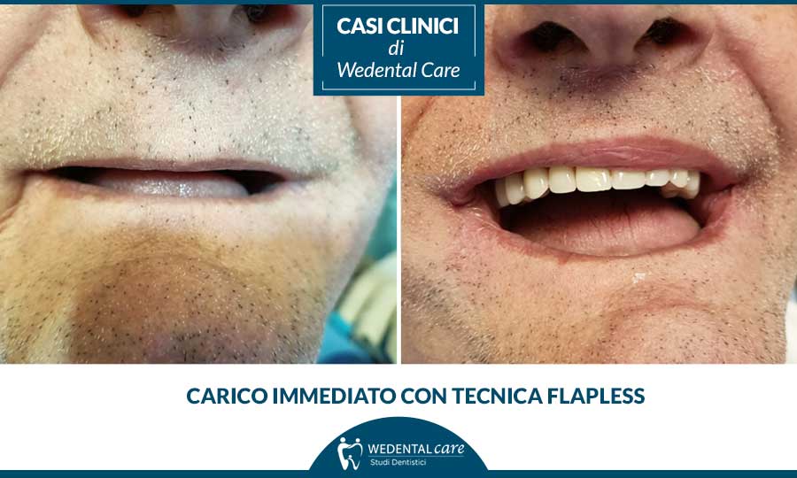 Carico immediato con tecnica Flapless