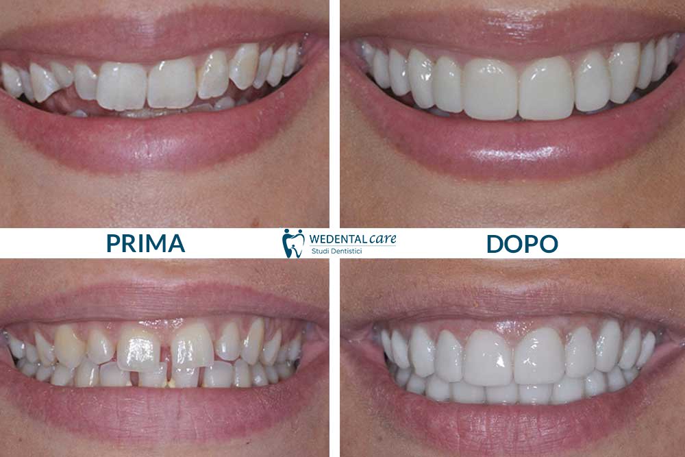 Faccette dentali costo: faccette estetiche non invasive