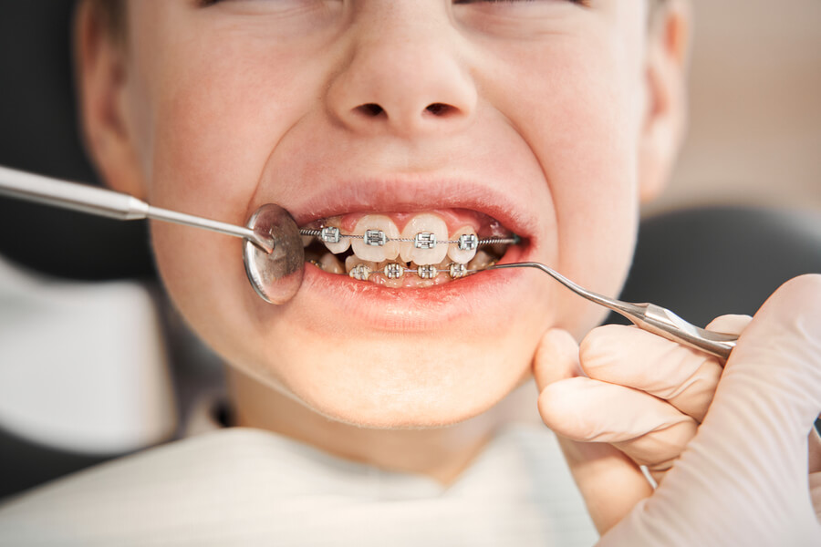 Apparecchio denti bambini: tipologie, vantaggi e consigli