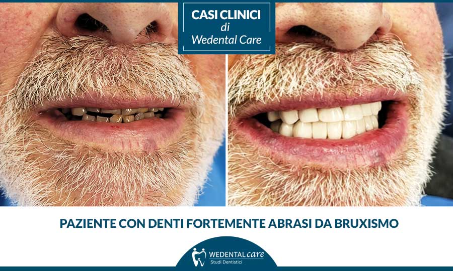 Denti abrasi da bruxismo