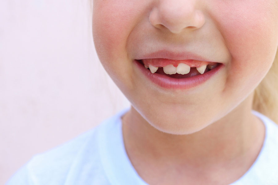 Perchè il bambino ha i denti storti? Come si può intervenire? 