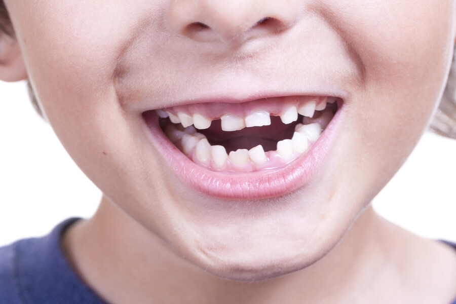 Perchè il bambino ha i denti storti? Come si può intervenire? 