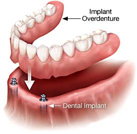 Impianti Overdenture