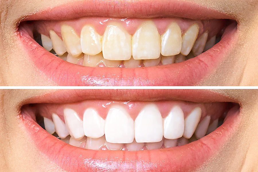 Sbiancamento dei denti prima e dopo