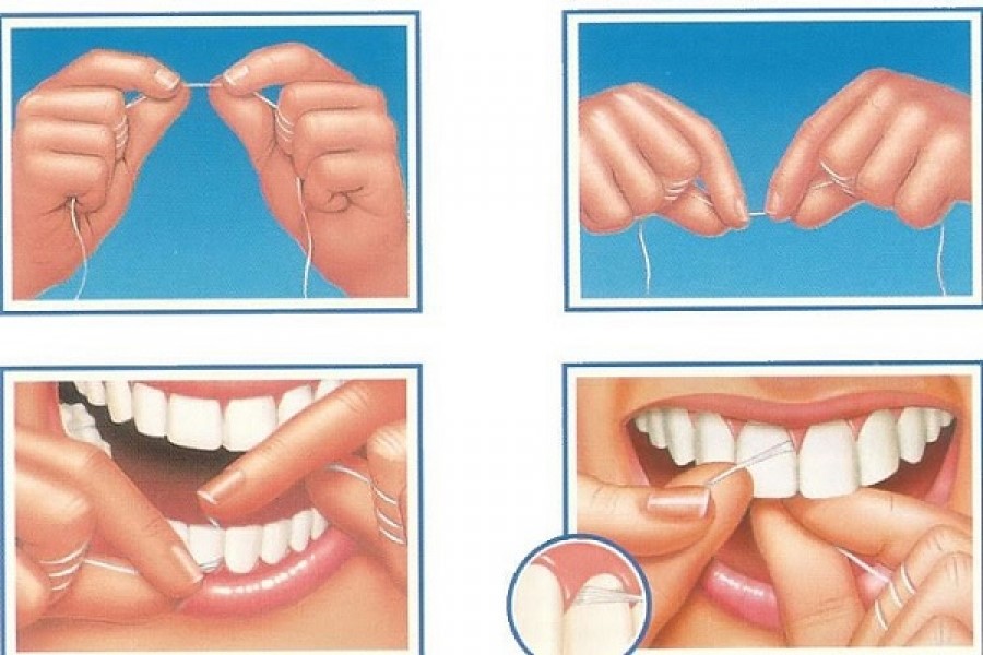 tecnica filo interdentale