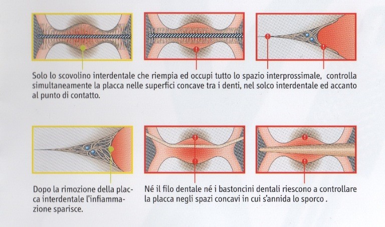 tecnica scovolino