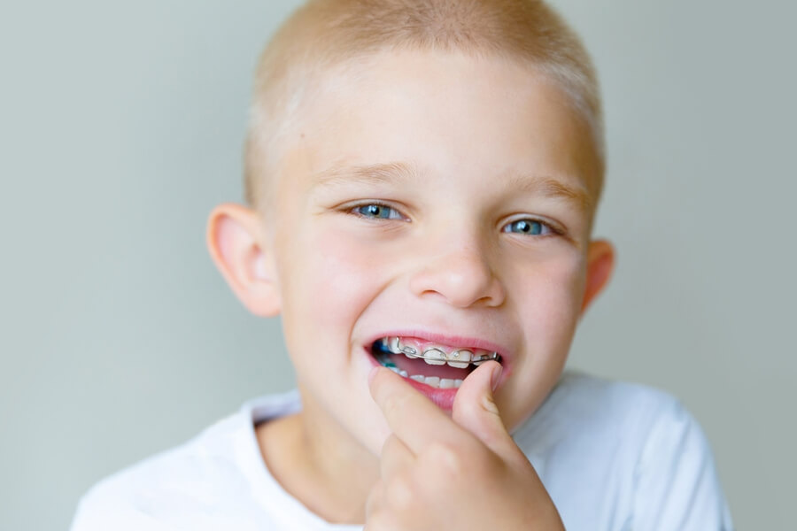 Ortodonzia intercettiva età pediatrica