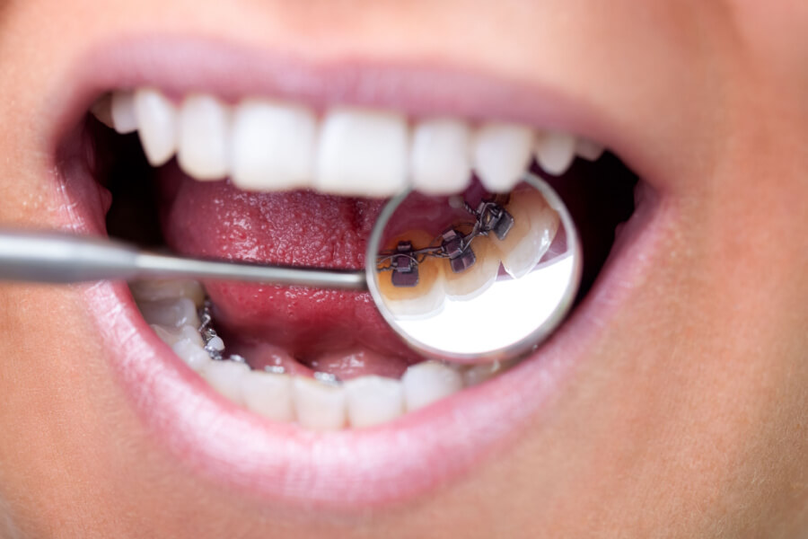 Cos'è l'apparecchio per denti interno e quando utilizzarlo