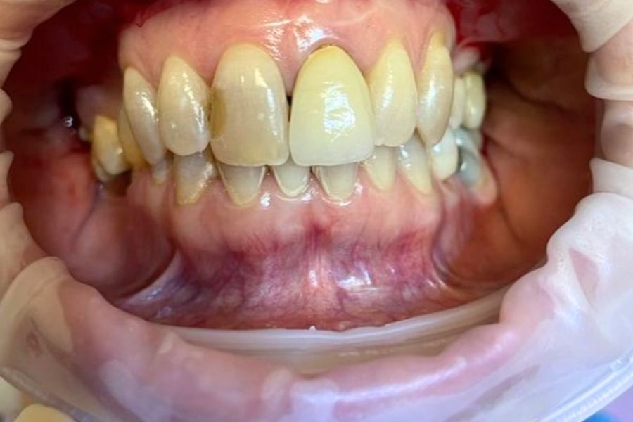 Zirconia caso clinico