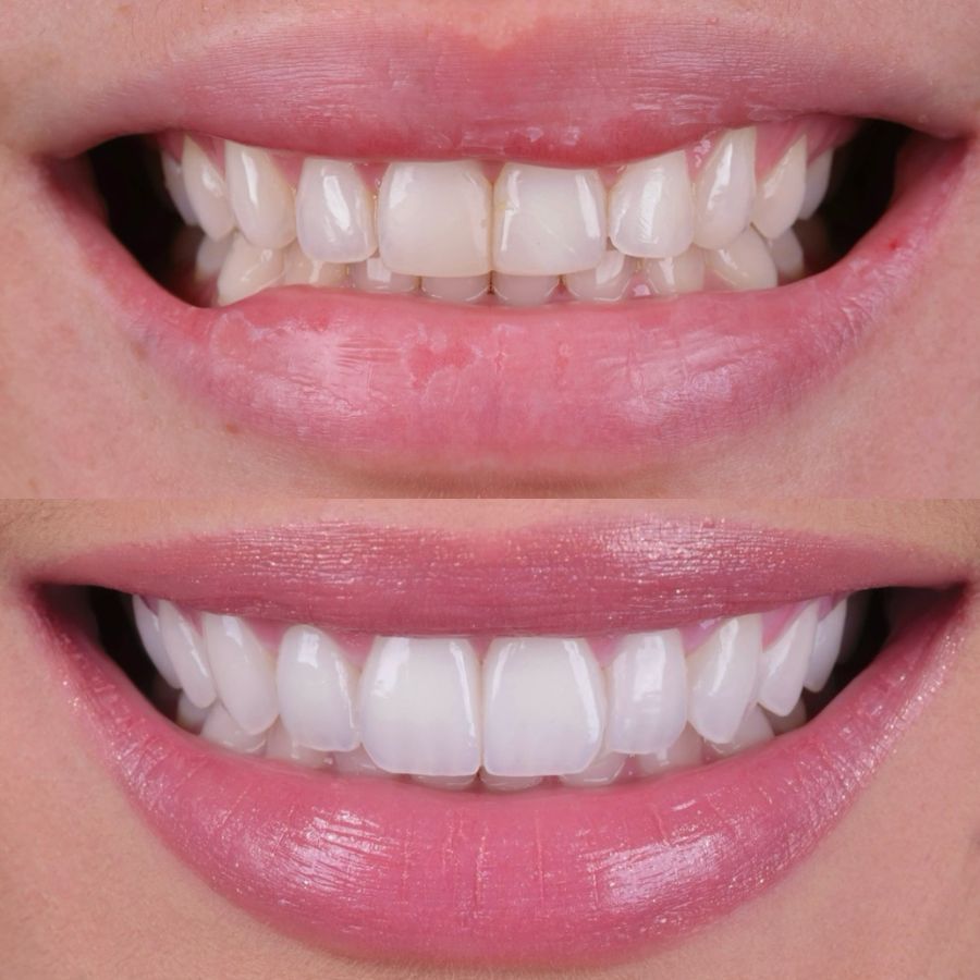 faccette-estetiche-slide-1