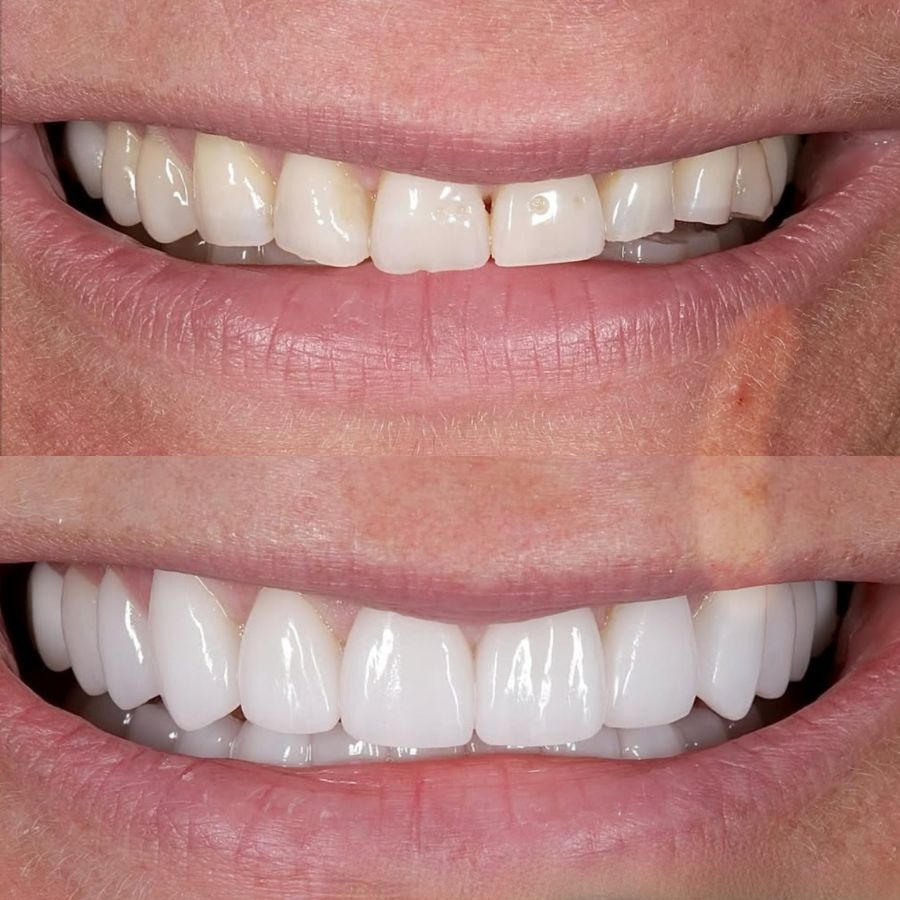 faccette-estetiche-slide-10