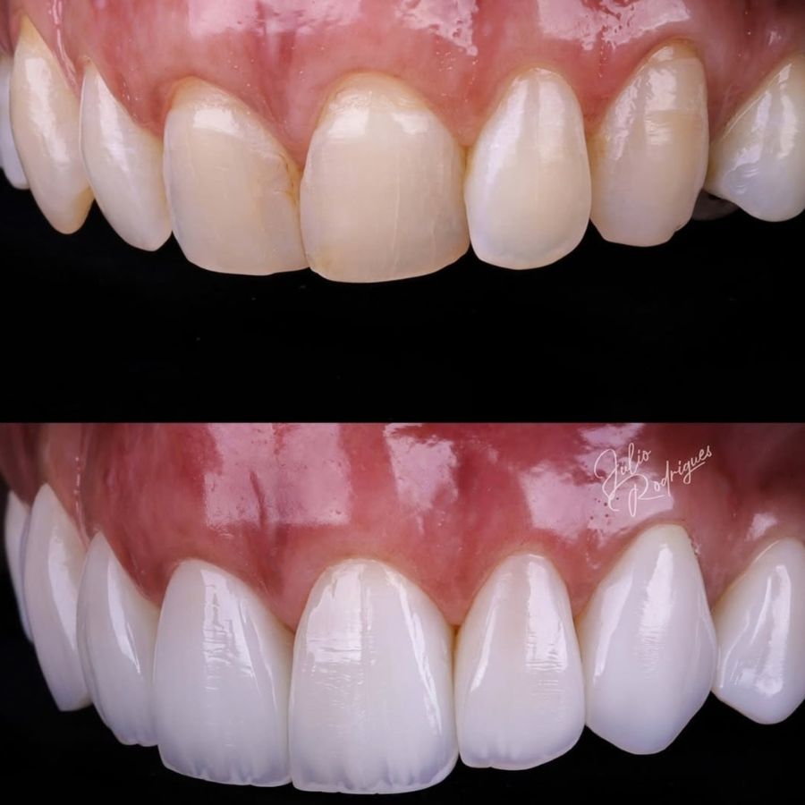 faccette-estetiche-slide-11
