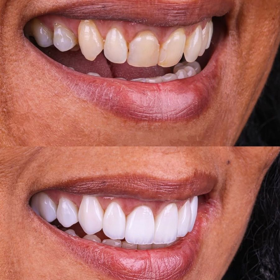 faccette-estetiche-slide-2