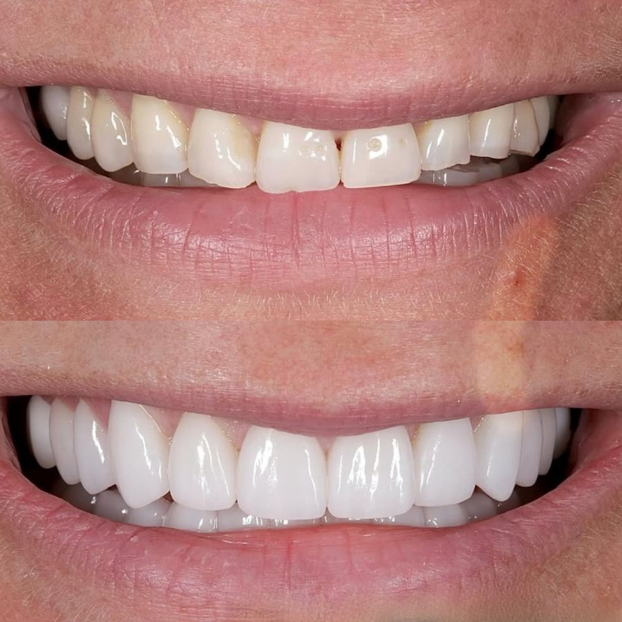 faccette-estetiche-slide-3
