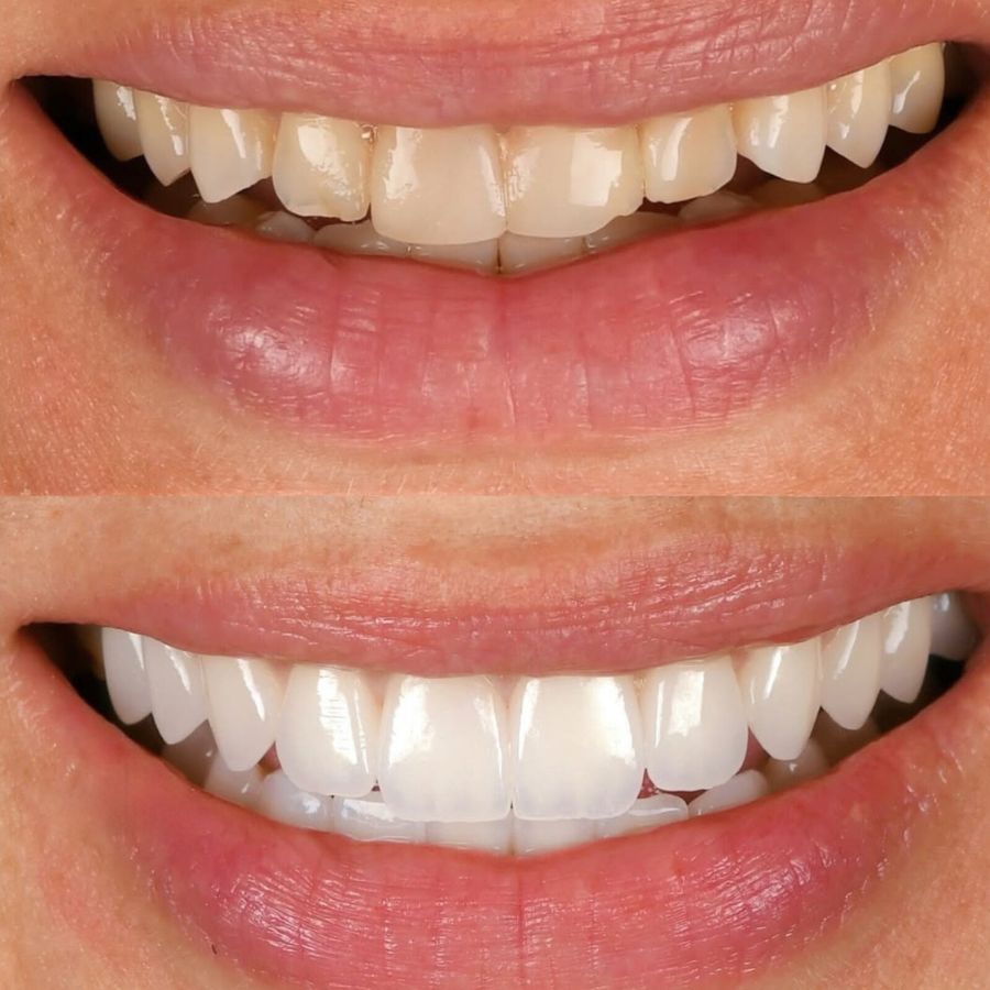 faccette-estetiche-slide-4