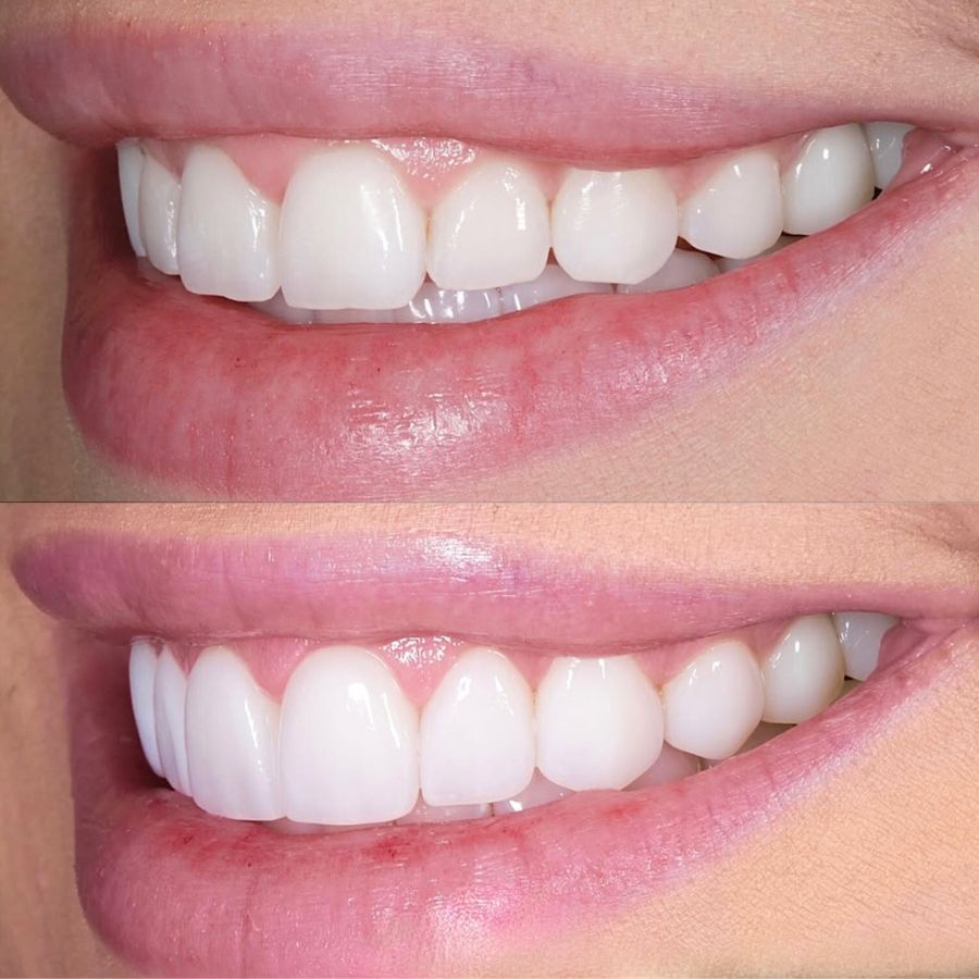 faccette-estetiche-slide-5