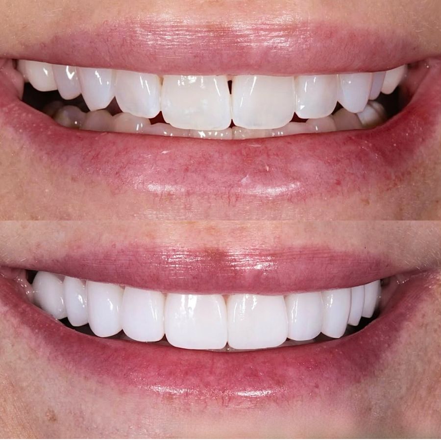 faccette-estetiche-slide-6