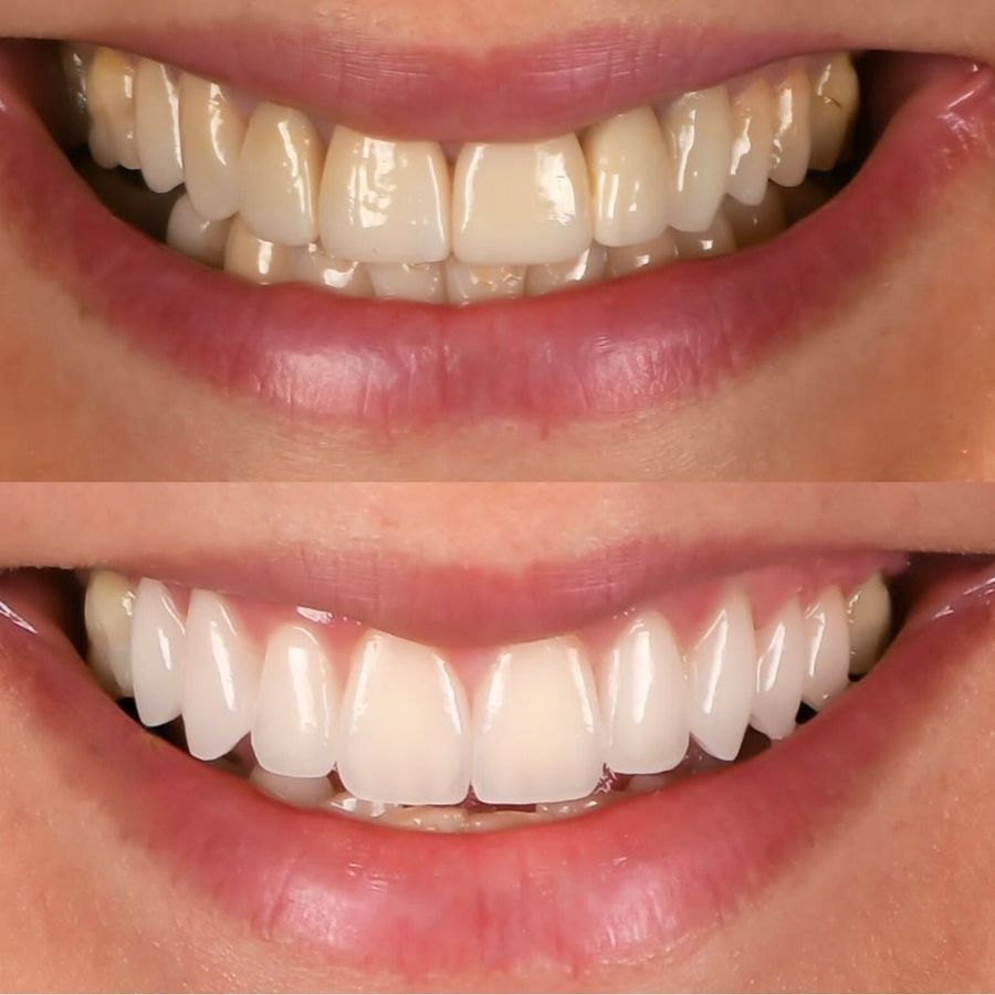 faccette-estetiche-slide-7