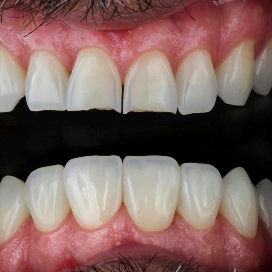 faccette-estetiche-slide-8