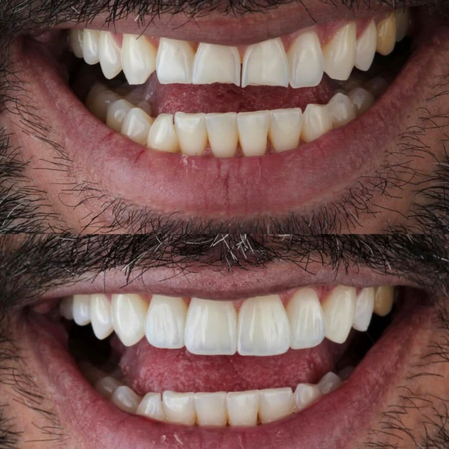 faccette-estetiche-slide-9