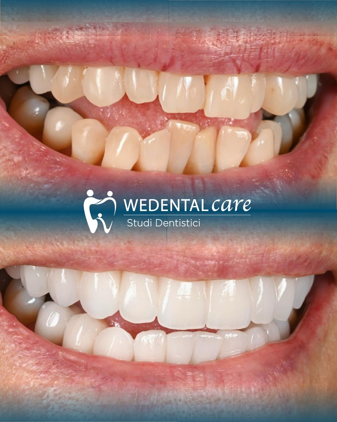 Corone in zirconio, dove riabilitare il sorriso a Roma