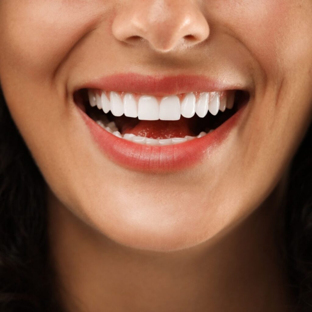 sorriso-faccette